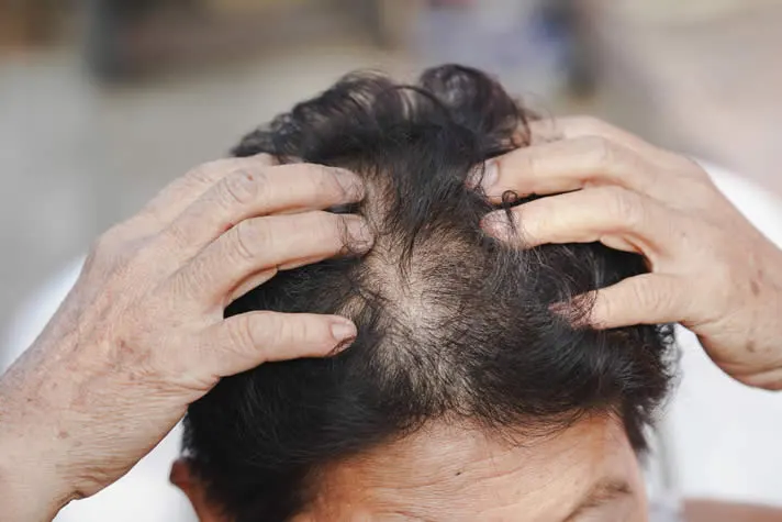 older-woman-hair-thinning